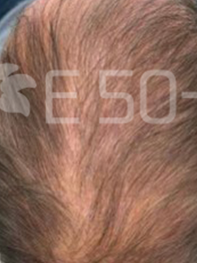 exosomes hair - Before