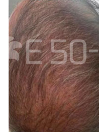 exosomes hair - After
