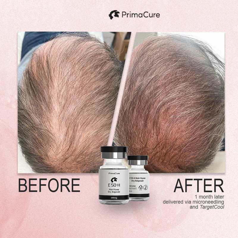 Exosome Hair Rejuvenation