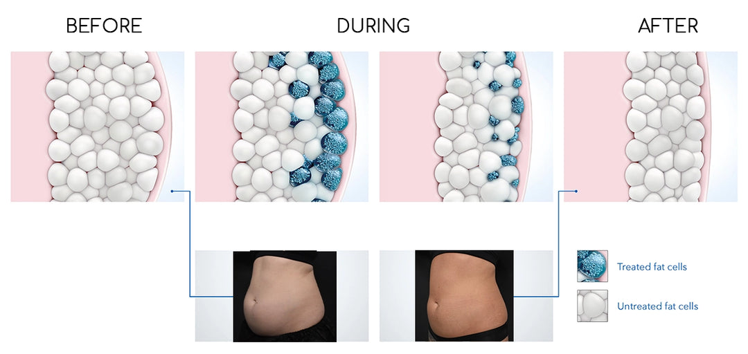 What is CoolSculpting?