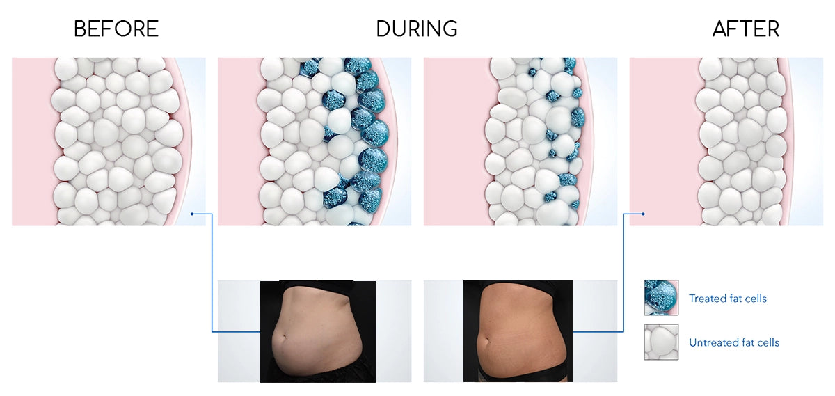 What is CoolSculpting?