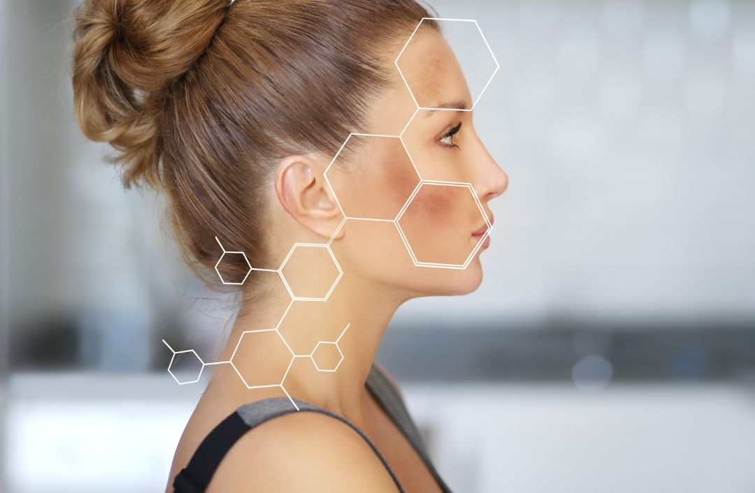 Understanding And Treating Hyperpigmentation