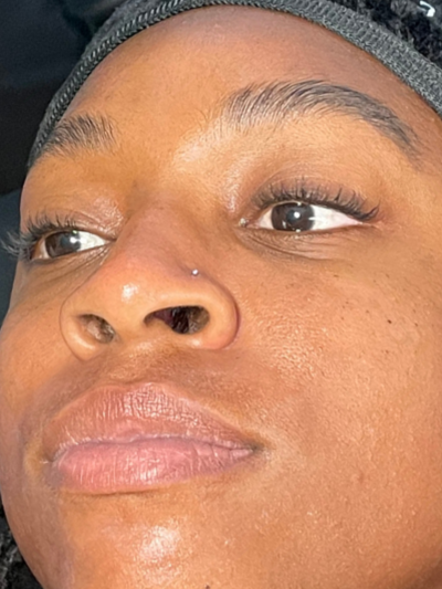 hydrafacial - After