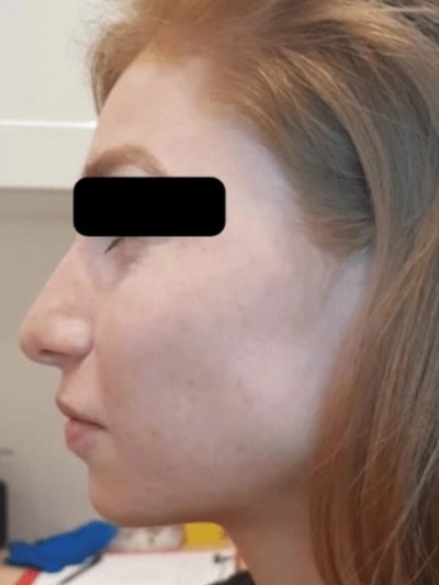 dermal 8 - Before