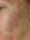 skinpen - Before