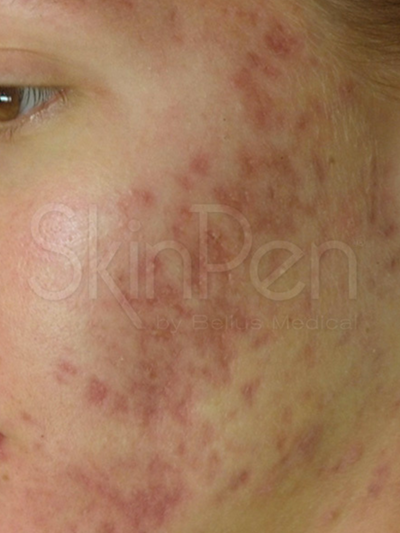skinpen - Before
