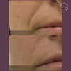 Hydrafacial Platinum (New)
