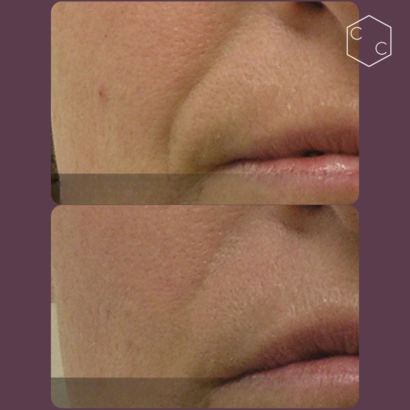 Hydrafacial Platinum (New)