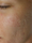 skinpen - After