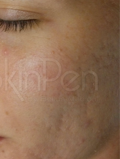 skinpen - After