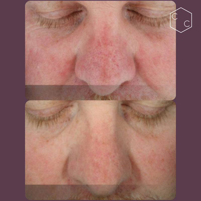 Hydrafacial Platinum (New)