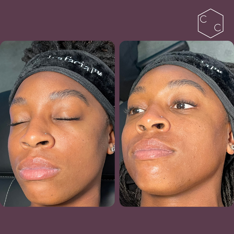 Hydrafacial Platinum (New)