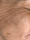 skinpen 2 - Before