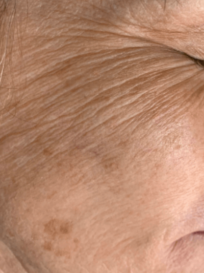 skinpen 2 - Before
