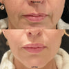 Dermal Lip Filler