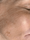 skinpen 2 - After