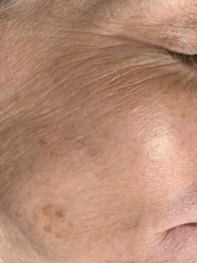 skinpen 2 - After