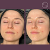 Hydrafacial Platinum (New)