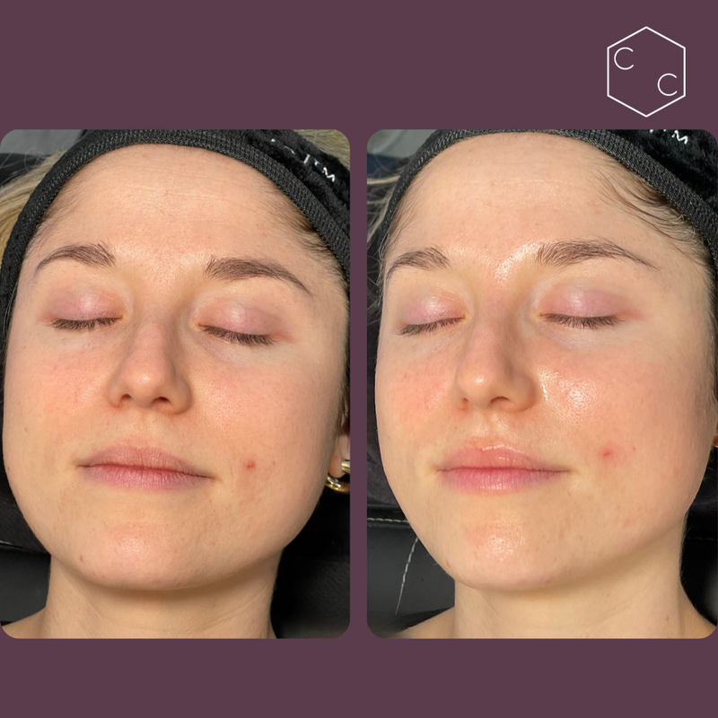 Hydrafacial Platinum (New)
