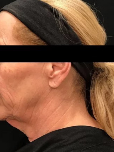 facetite 2 - Before