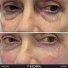 Polynucleotides (Face & Under Eyes)