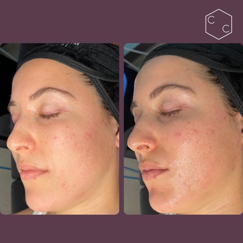 Hydrafacial Platinum (New)