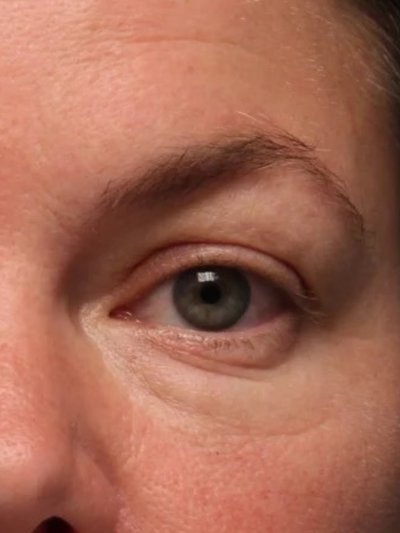 facetite 3 - Before