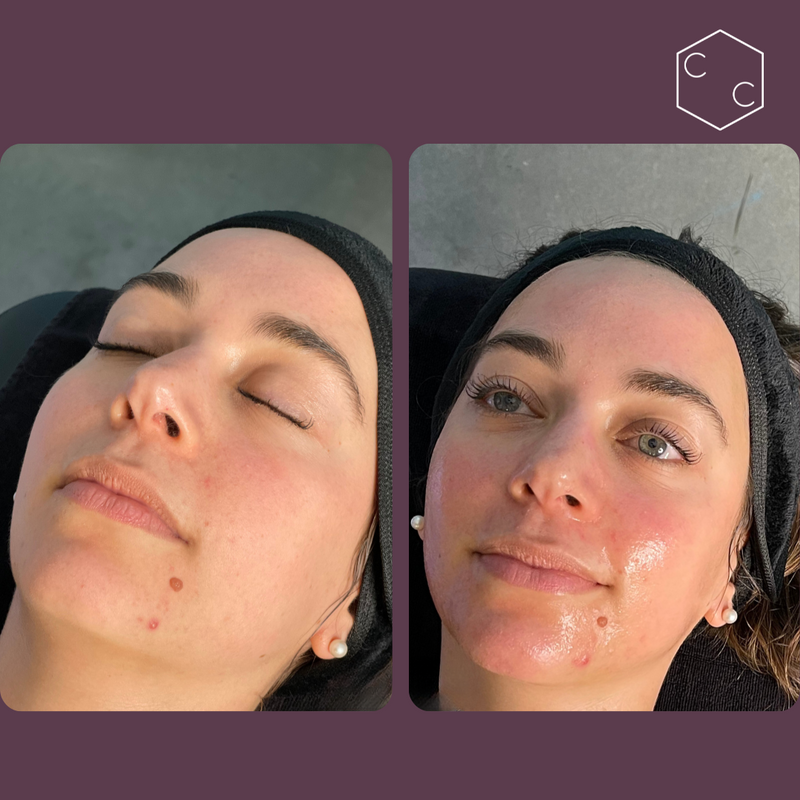 Hydrafacial Platinum (New)