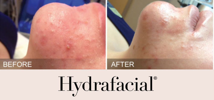 Hydrafacial