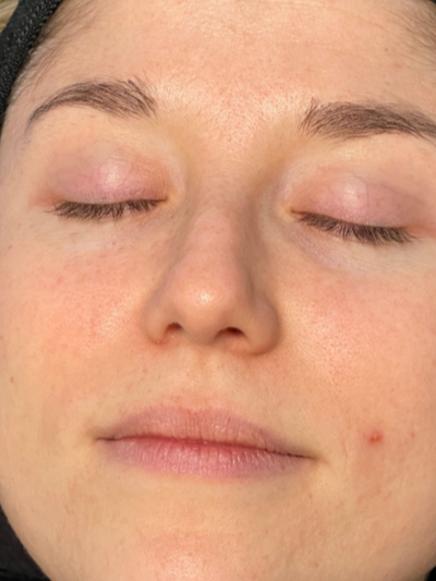 hydrafacial - Before
