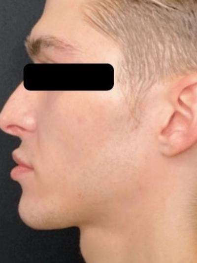 dermal 5 - Before