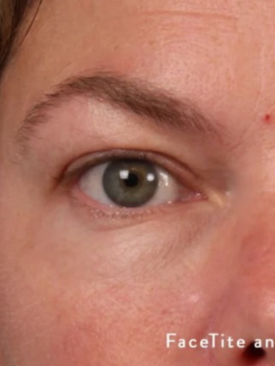 facetite 3 - After