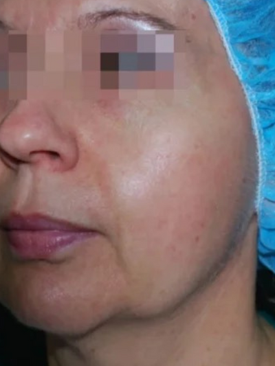 facetite - Before