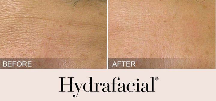 Hydrafacial