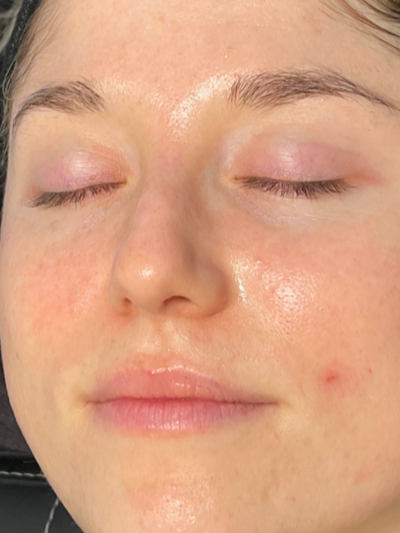hydrafacial - After