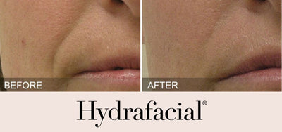 Hydrafacial