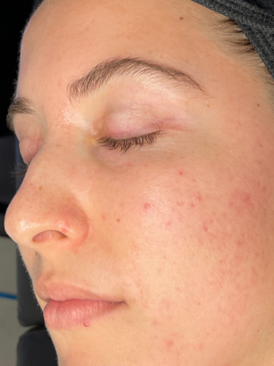 hydrafacial - Before