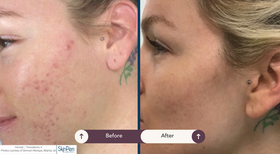 Skinpen Microneedling