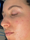 hydrafacial - After