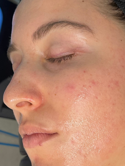 hydrafacial - After