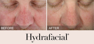 Hydrafacial