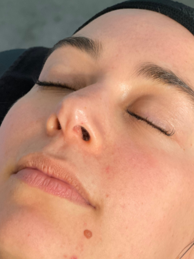 hydrafacial - Before