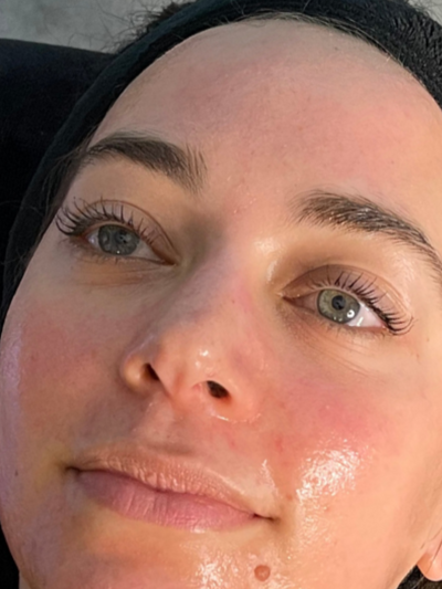 hydrafacial - After