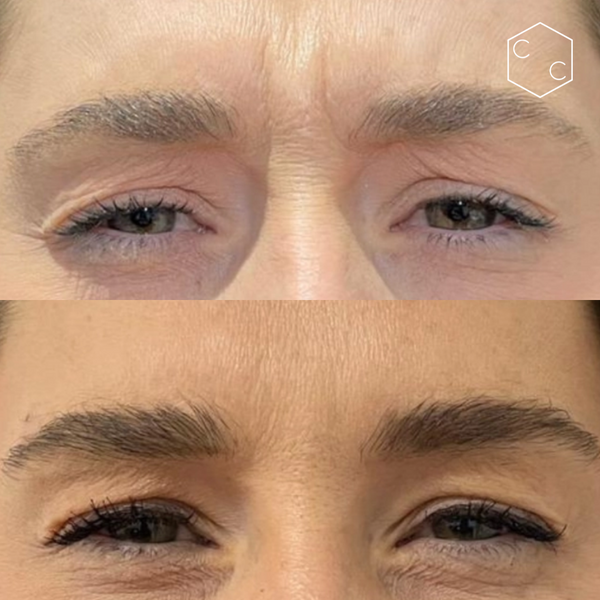 Anti-Wrinkle Treatments