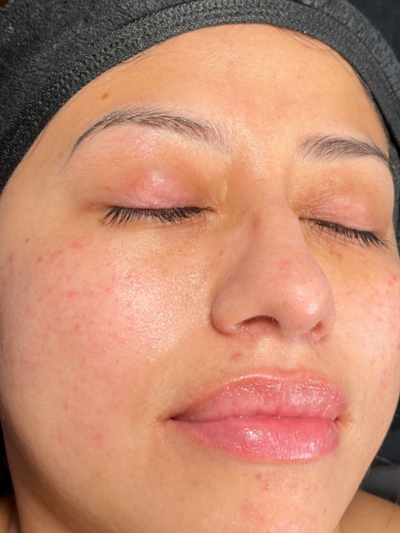 hydrafacial - Before