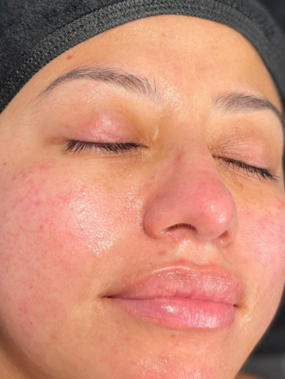 hydrafacial - After