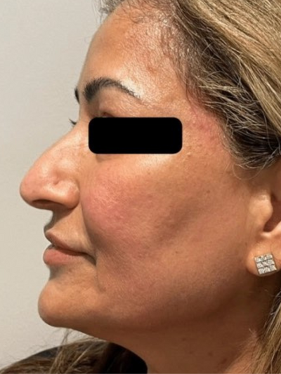 dermal 3 - Before