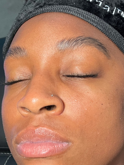 hydrafacial - Before