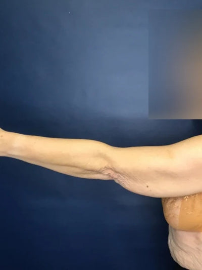 bodytite 2 - Before