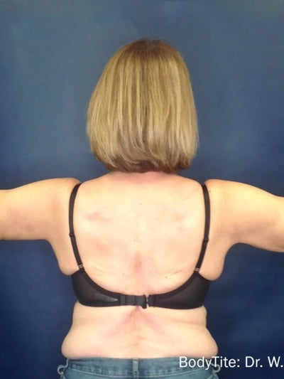 bodytite 3 - After